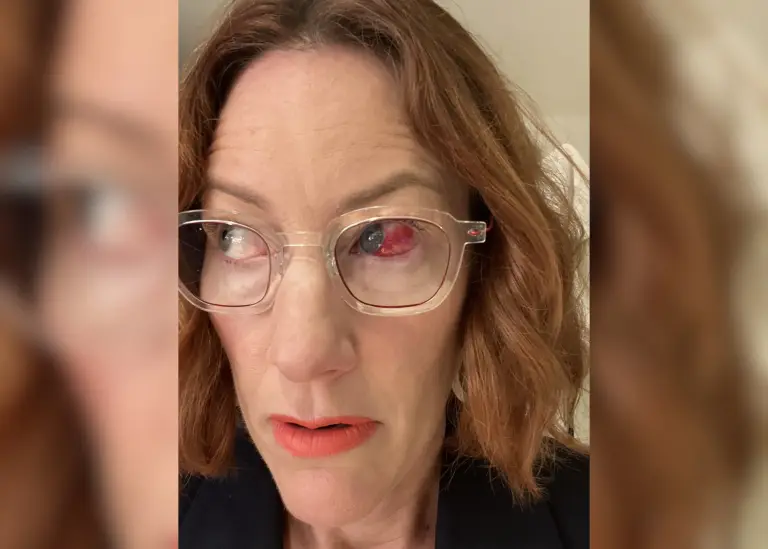 Subconjunctival Haemorrhages