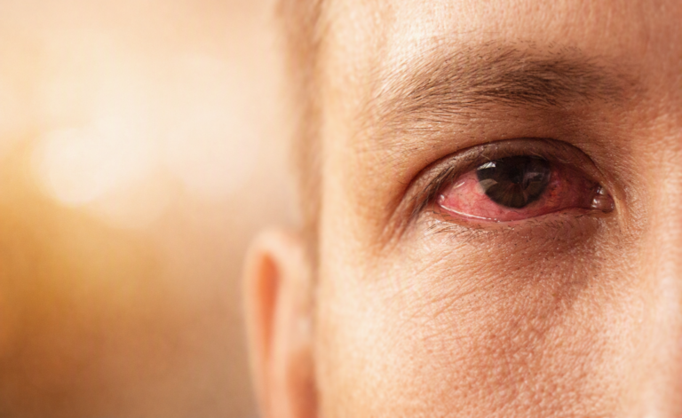 Dry Eye: More Than Just Dry, Tired Eyes